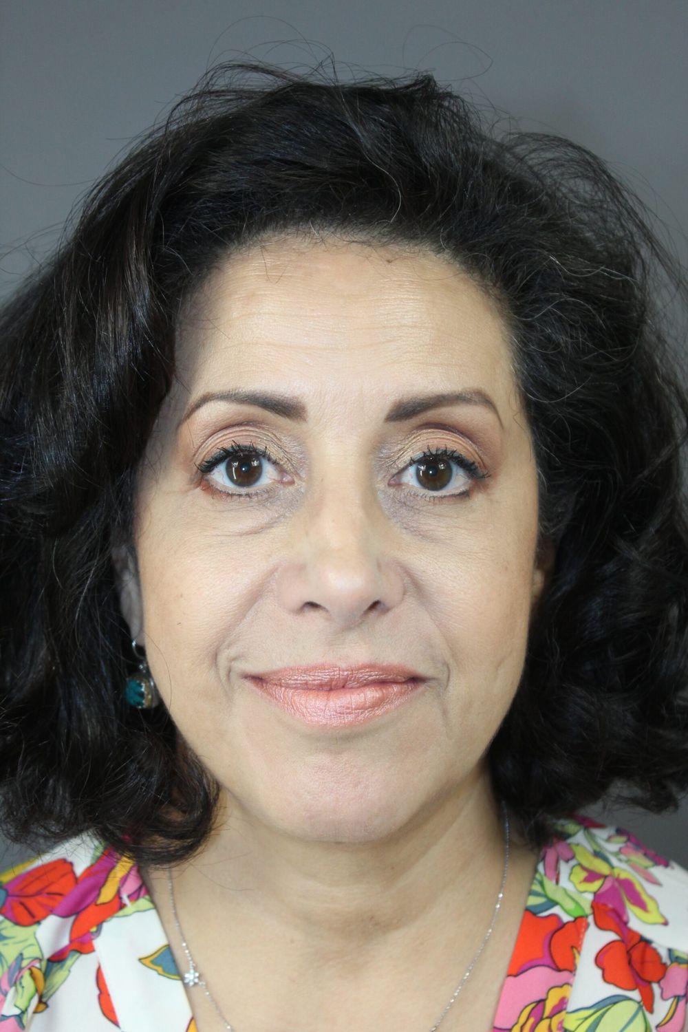 Rhinoplasty Before & After