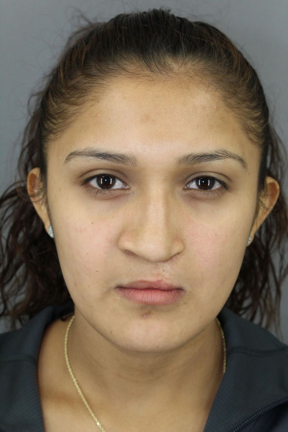 Rhinoplasty Before & After