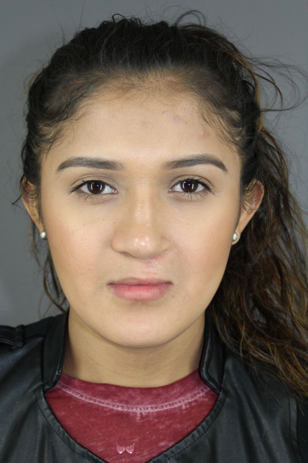 Rhinoplasty Before & After