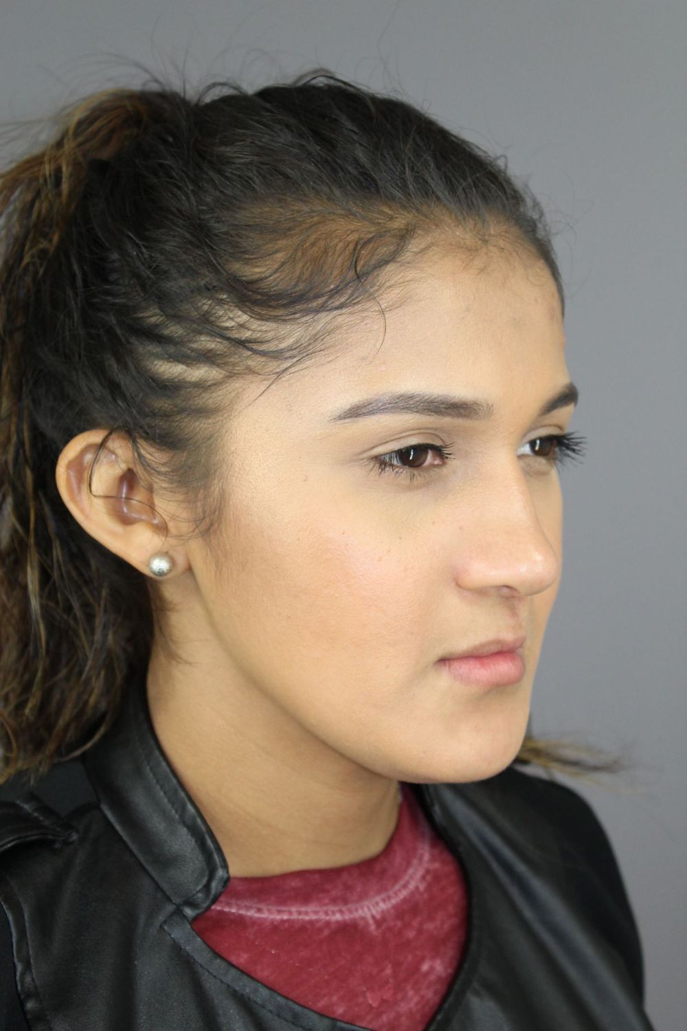 Rhinoplasty Before & After