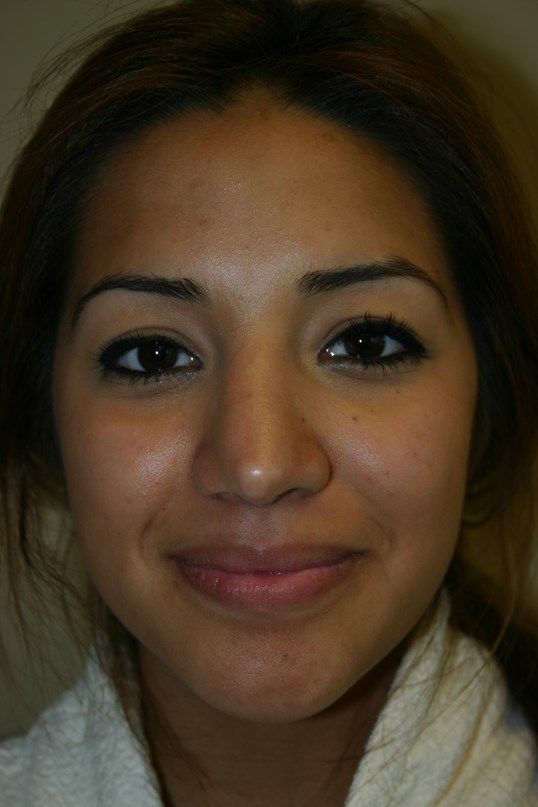 Rhinoplasty Before & After