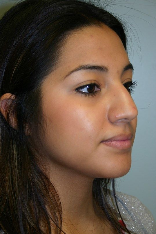 Rhinoplasty Before & After