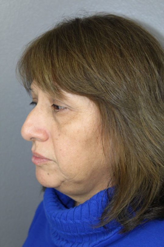 Rhinoplasty Before & After