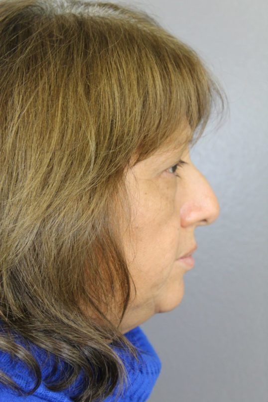 Rhinoplasty Before & After