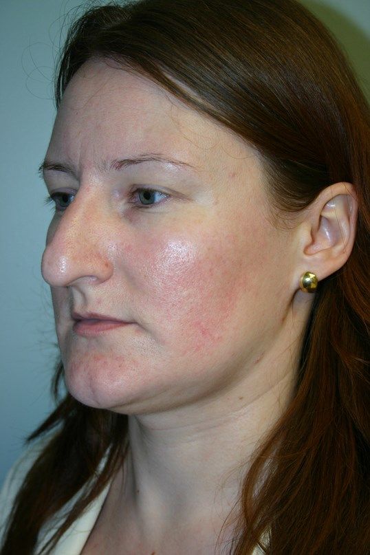 Rhinoplasty Before & After