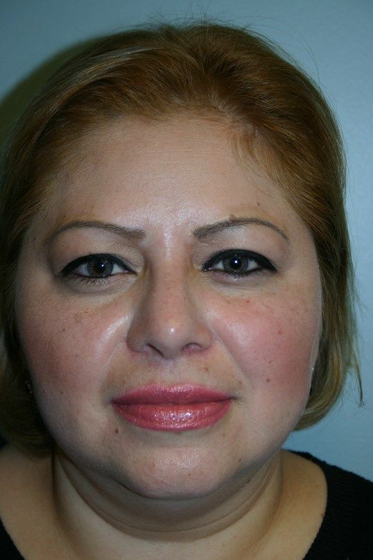 Rhinoplasty Before & After