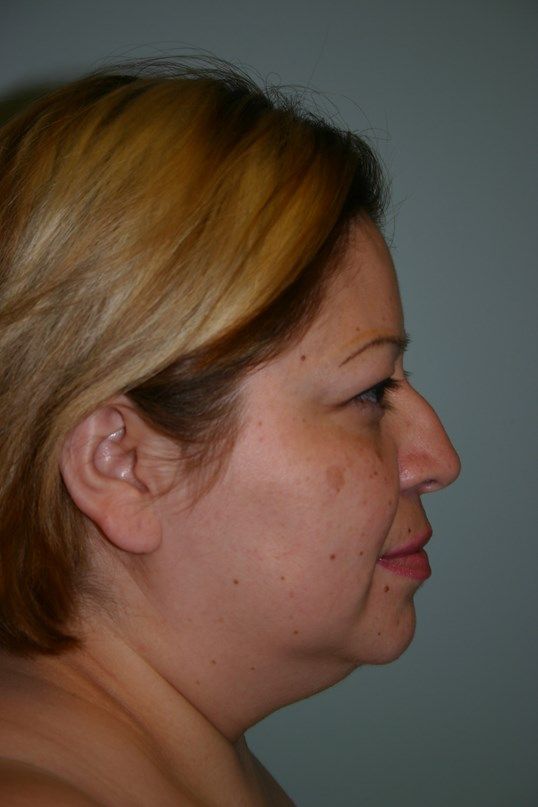 Rhinoplasty Before & After