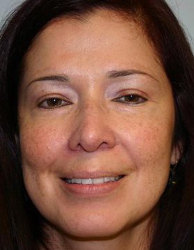 Rhinoplasty Before & After