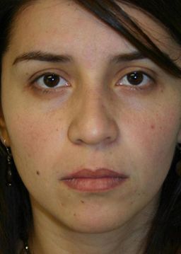 Rhinoplasty Before & After