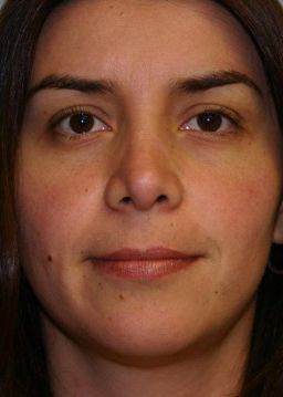 Rhinoplasty Before & After