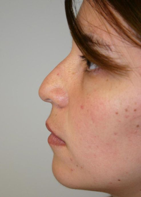 Rhinoplasty Before & After
