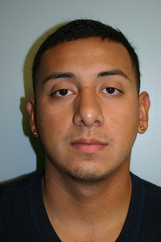 Rhinoplasty Before & After