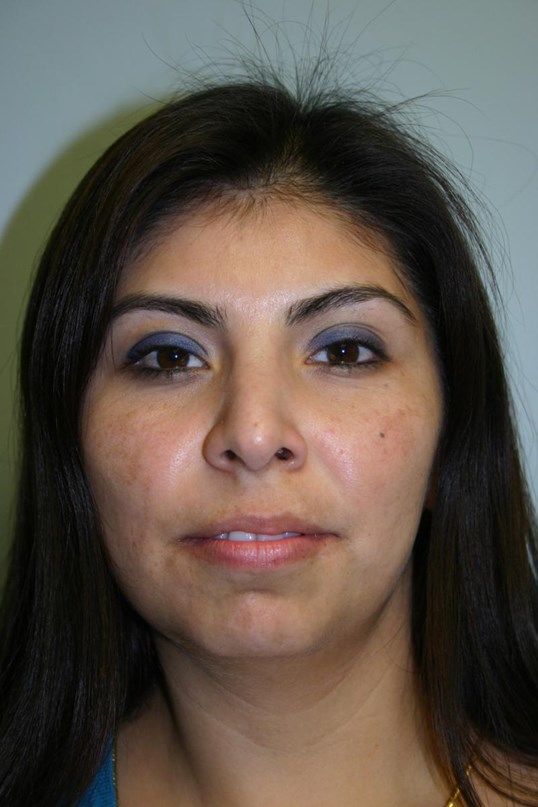 Rhinoplasty Before & After