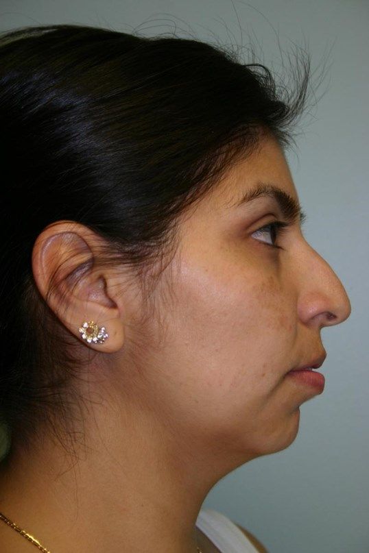 Rhinoplasty Before & After