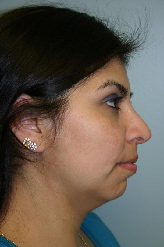 Rhinoplasty Before & After