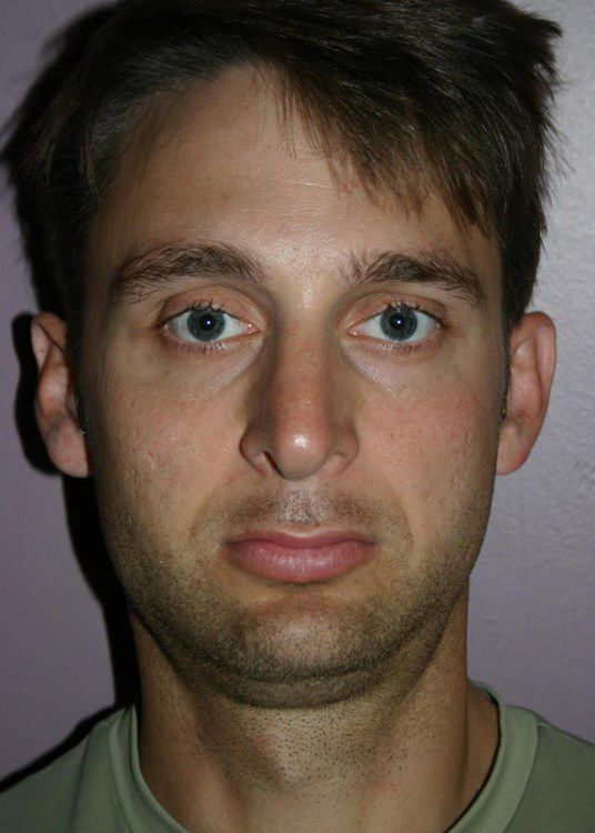 Rhinoplasty Before & After