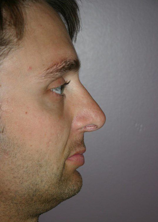 Rhinoplasty Before & After