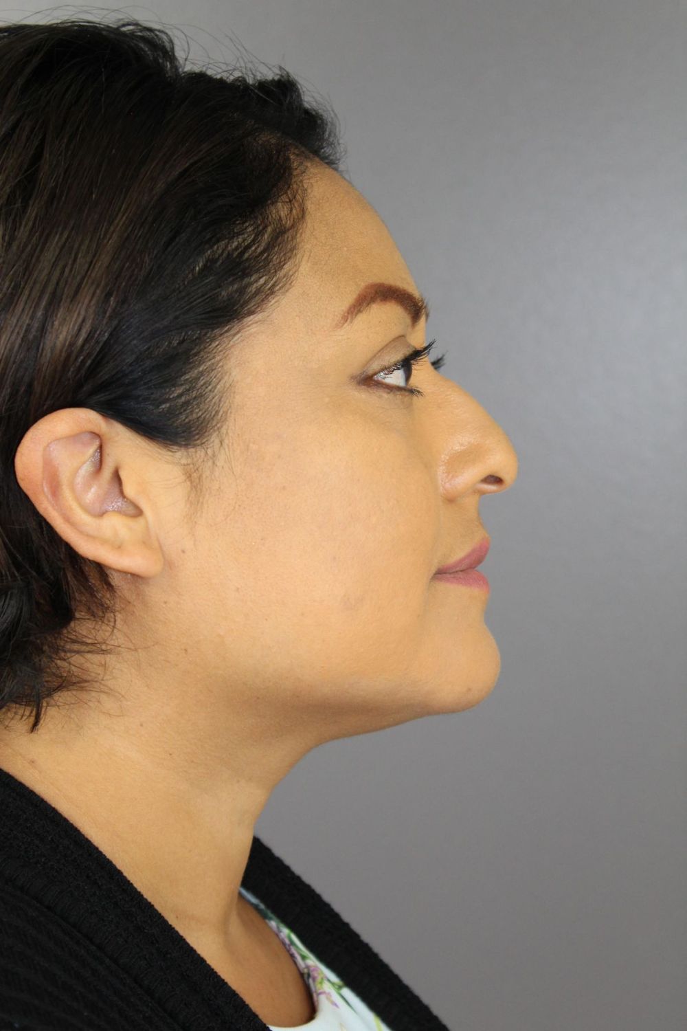 Rhinoplasty Before & After