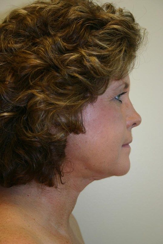 Juvederm Before & After