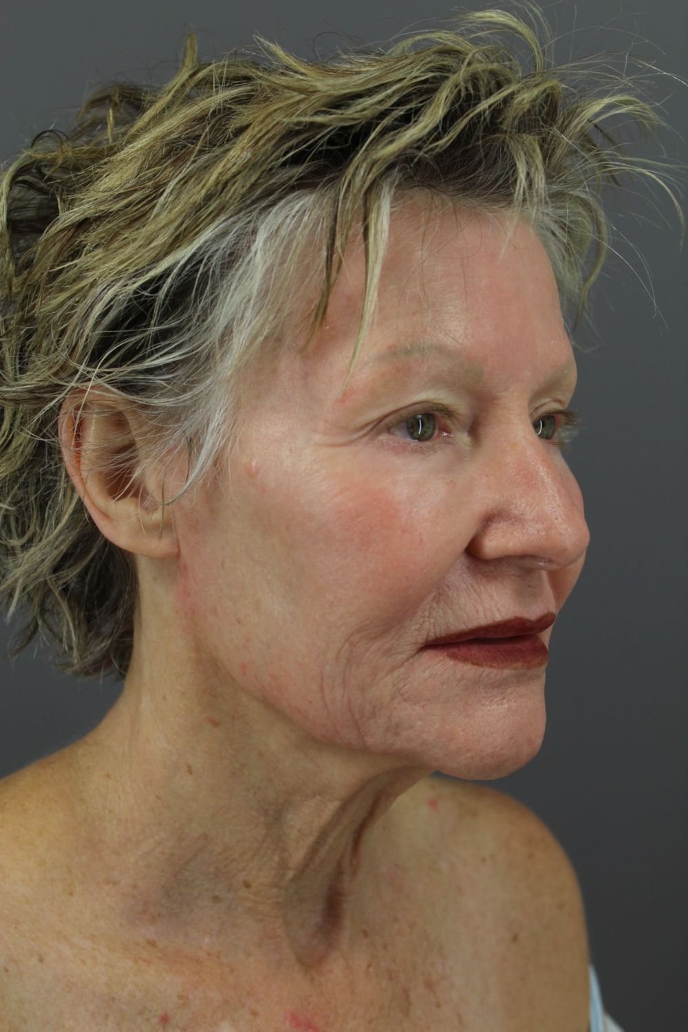 Juvederm Before & After