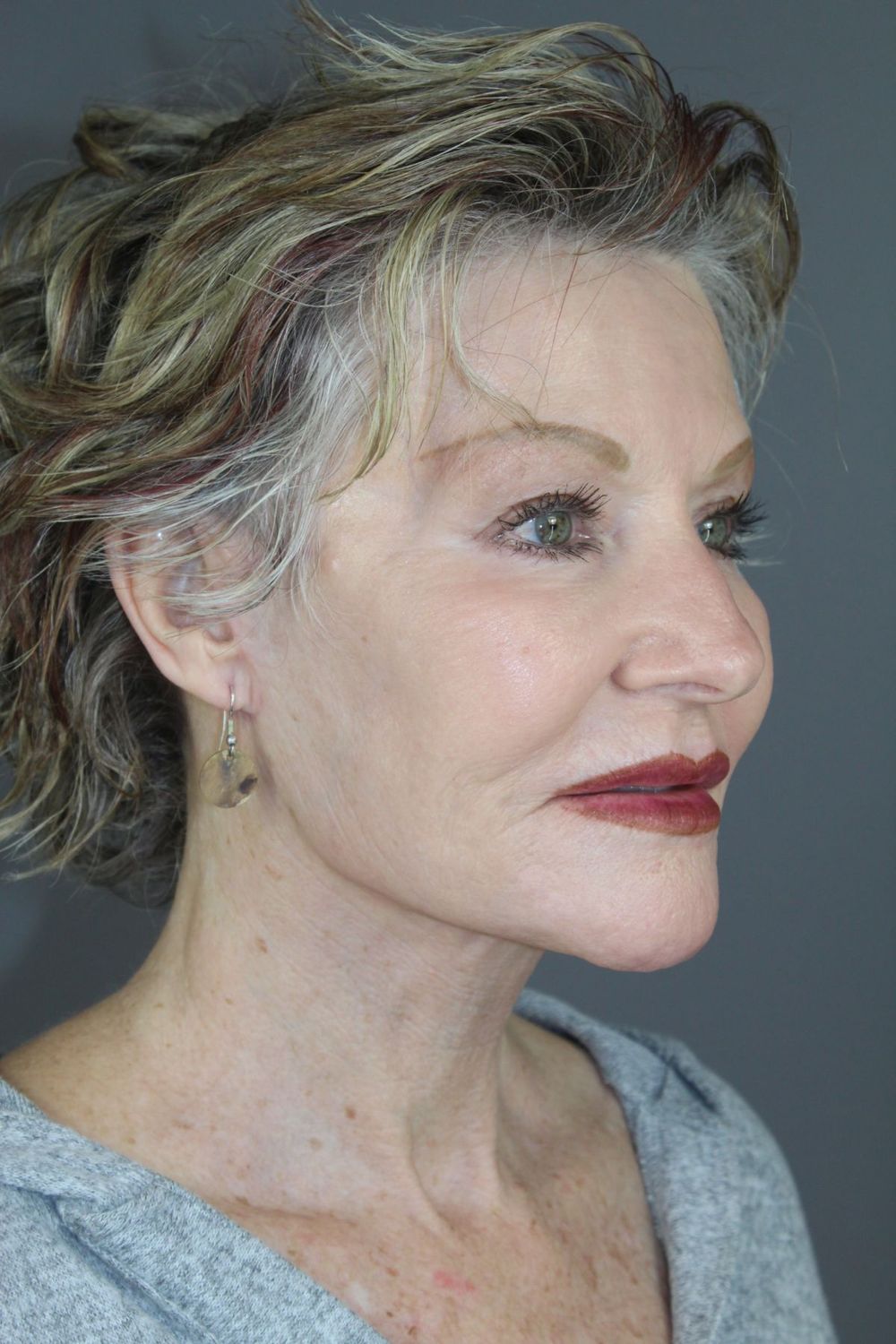 Juvederm Before & After