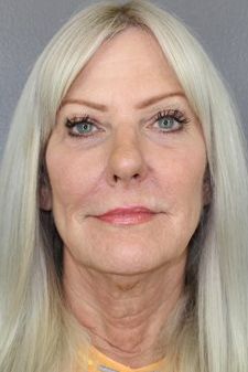 Juvederm Before & After