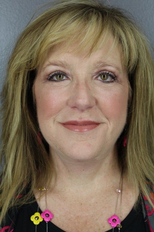 Juvederm Before & After