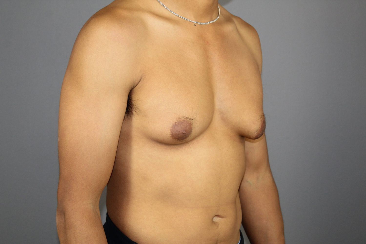 Gynecomastia Before & After