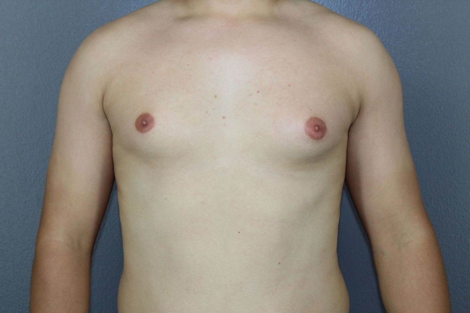 Gynecomastia Before & After