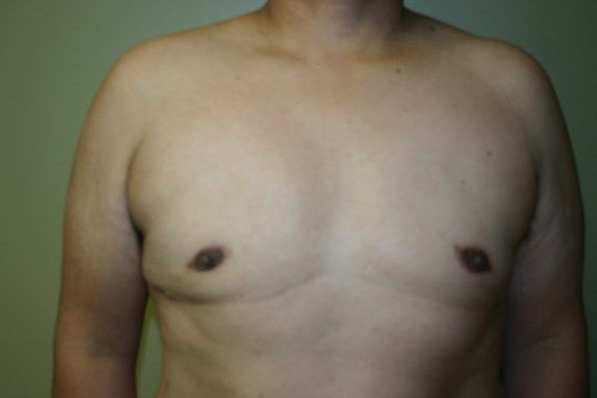 Gynecomastia Before & After
