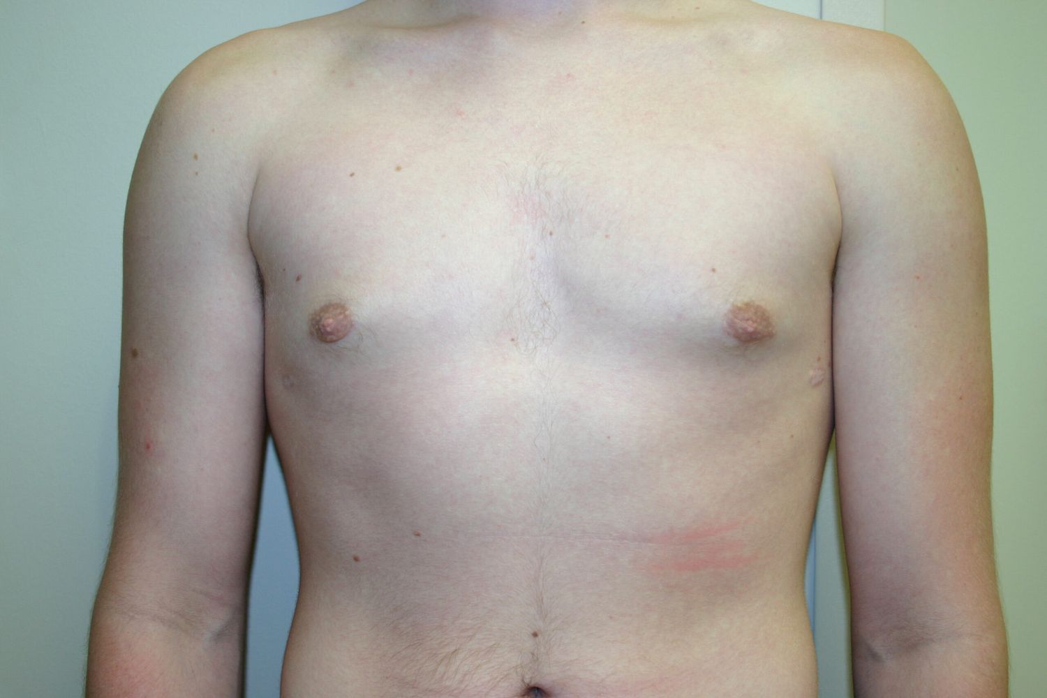 Gynecomastia Before & After