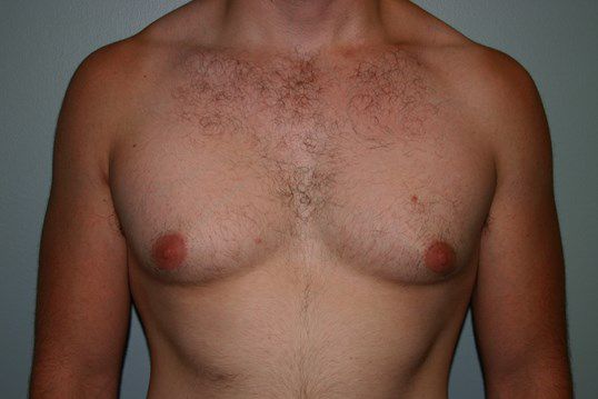 Gynecomastia Before & After