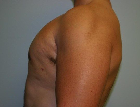 Gynecomastia Before & After