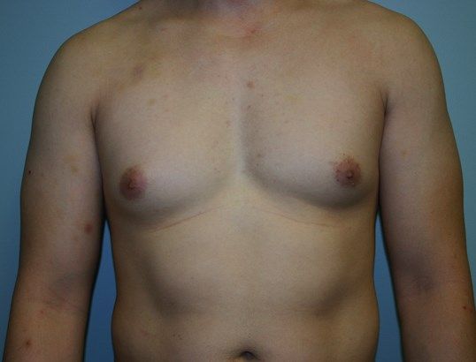 Gynecomastia Before & After