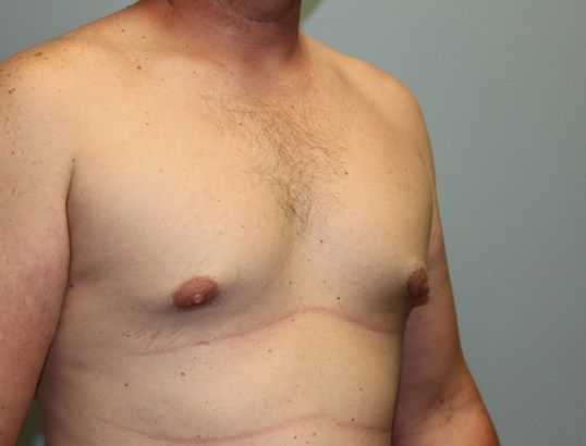 Gynecomastia Before & After