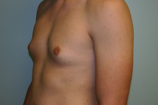 Gynecomastia Before & After