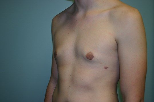 Gynecomastia Before & After