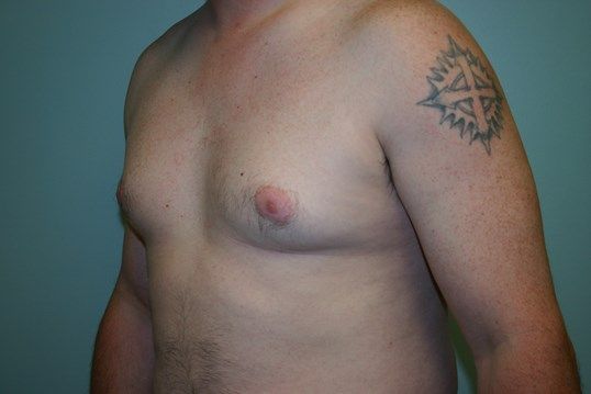Gynecomastia Before & After