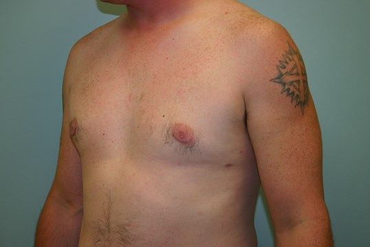 Gynecomastia Before & After