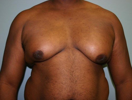 Gynecomastia Before & After