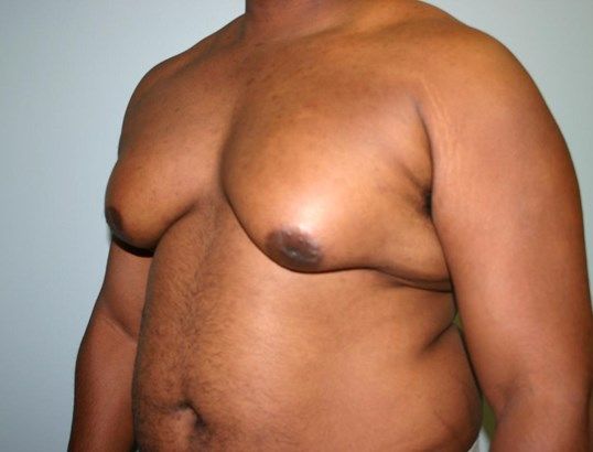 Gynecomastia Before & After