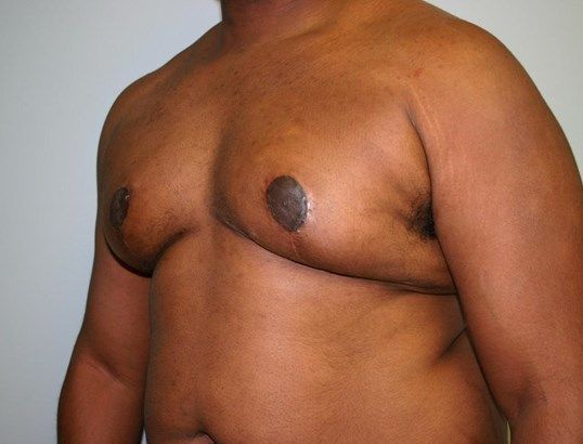 Gynecomastia Before & After