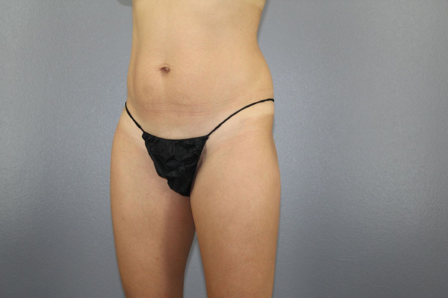 Mini Tummy Tuck Before & After