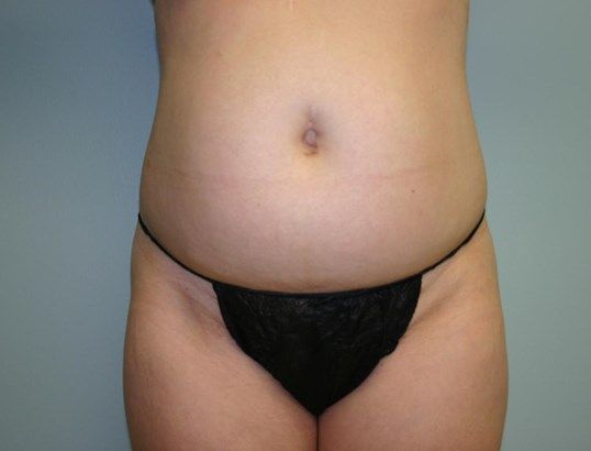 Mini Tummy Tuck Before & After