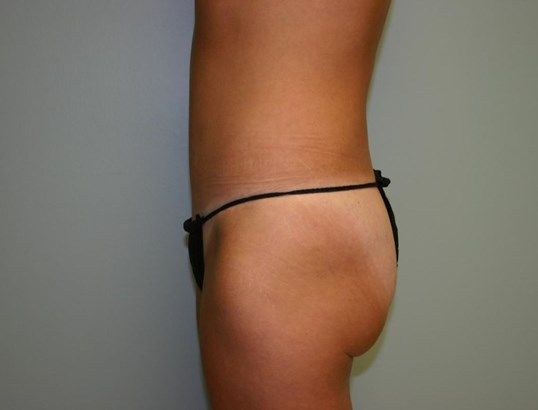 Mini Tummy Tuck Before & After