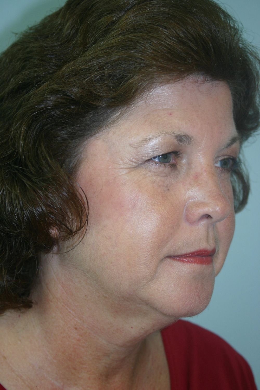 Botox Before & After