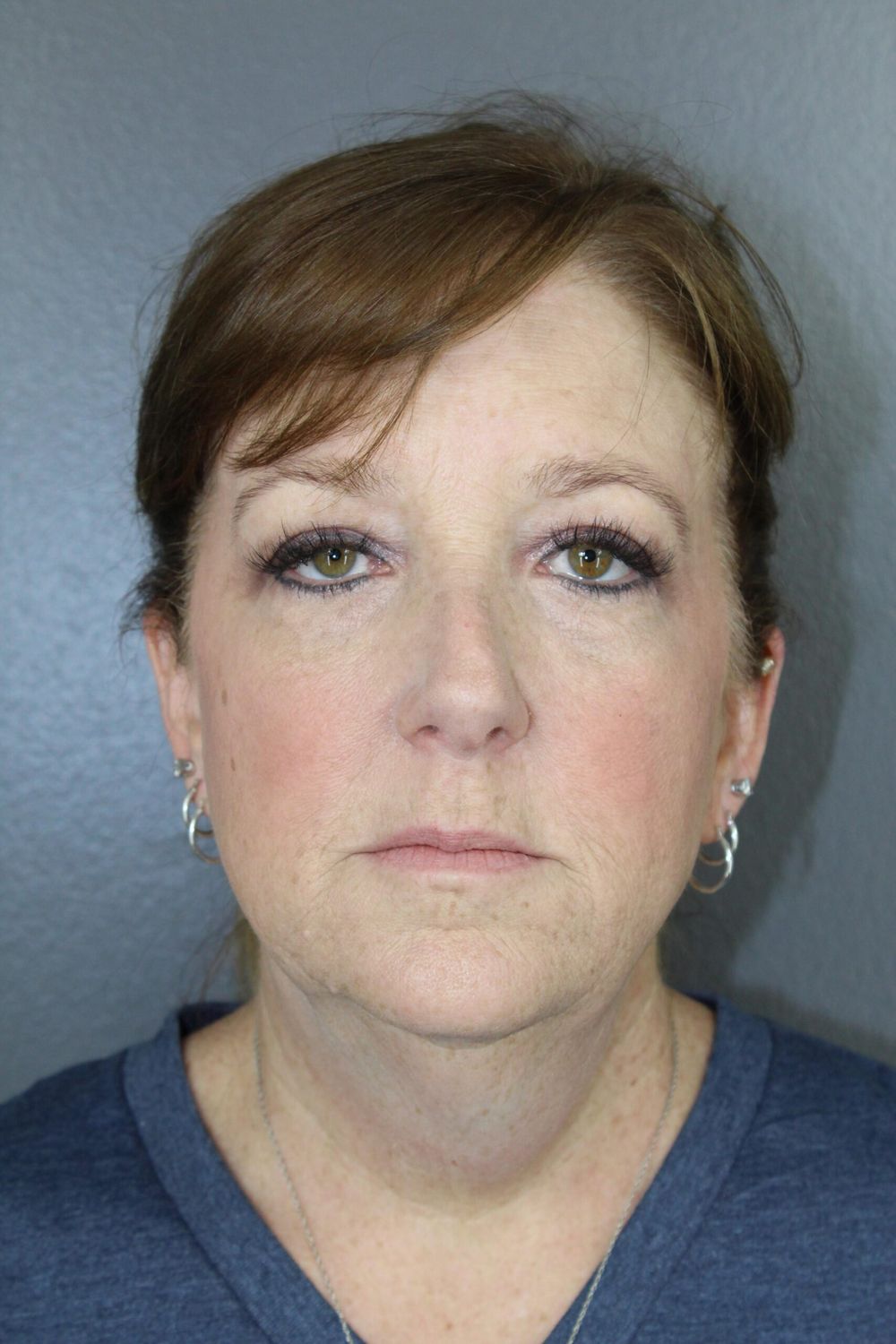 Botox Before & After