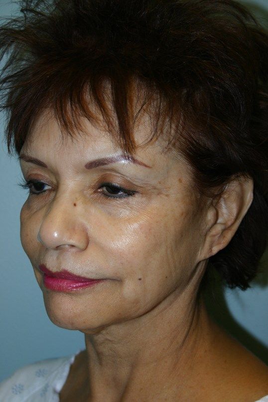 Botox Before & After