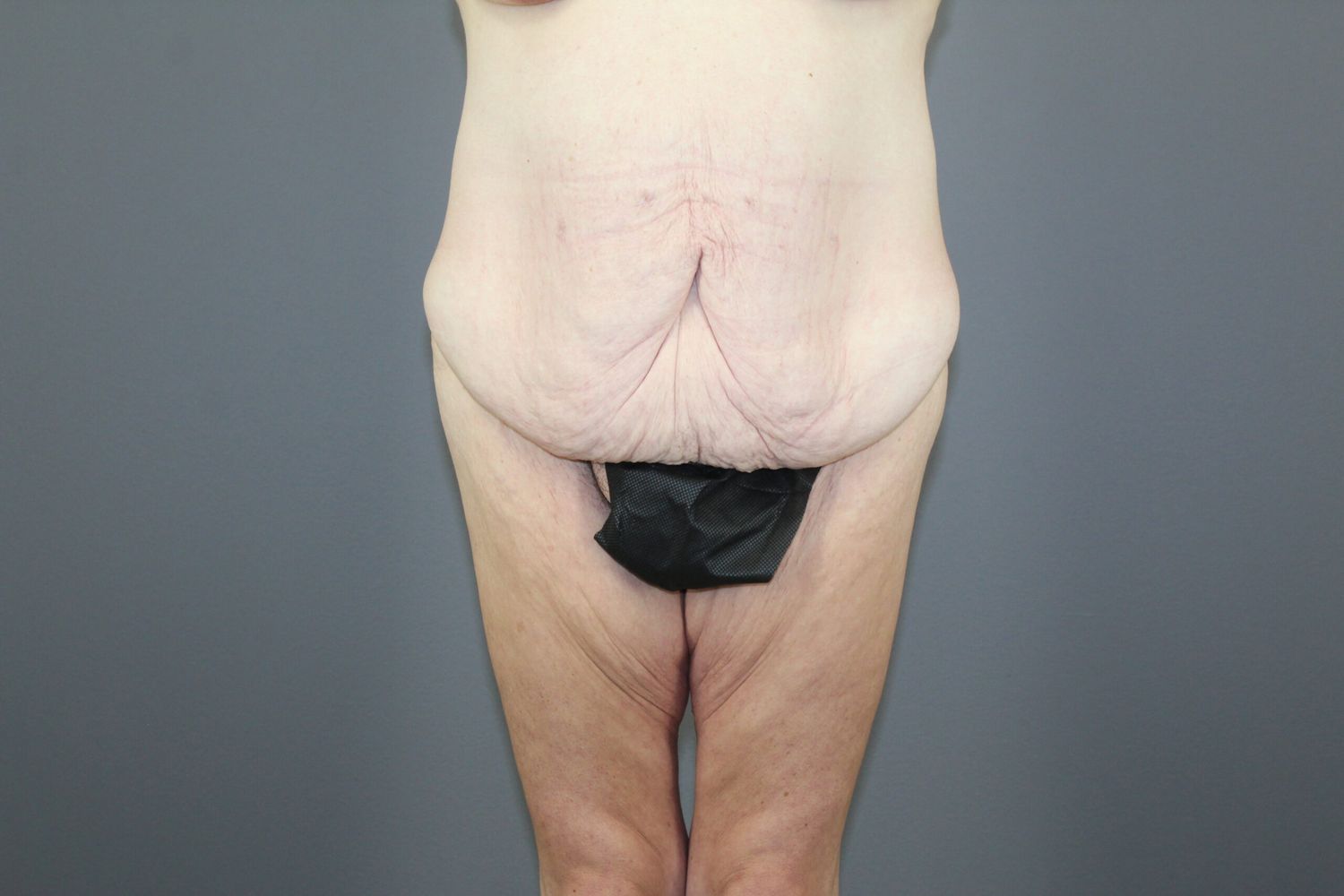 Surgery After Weight Loss Before & After