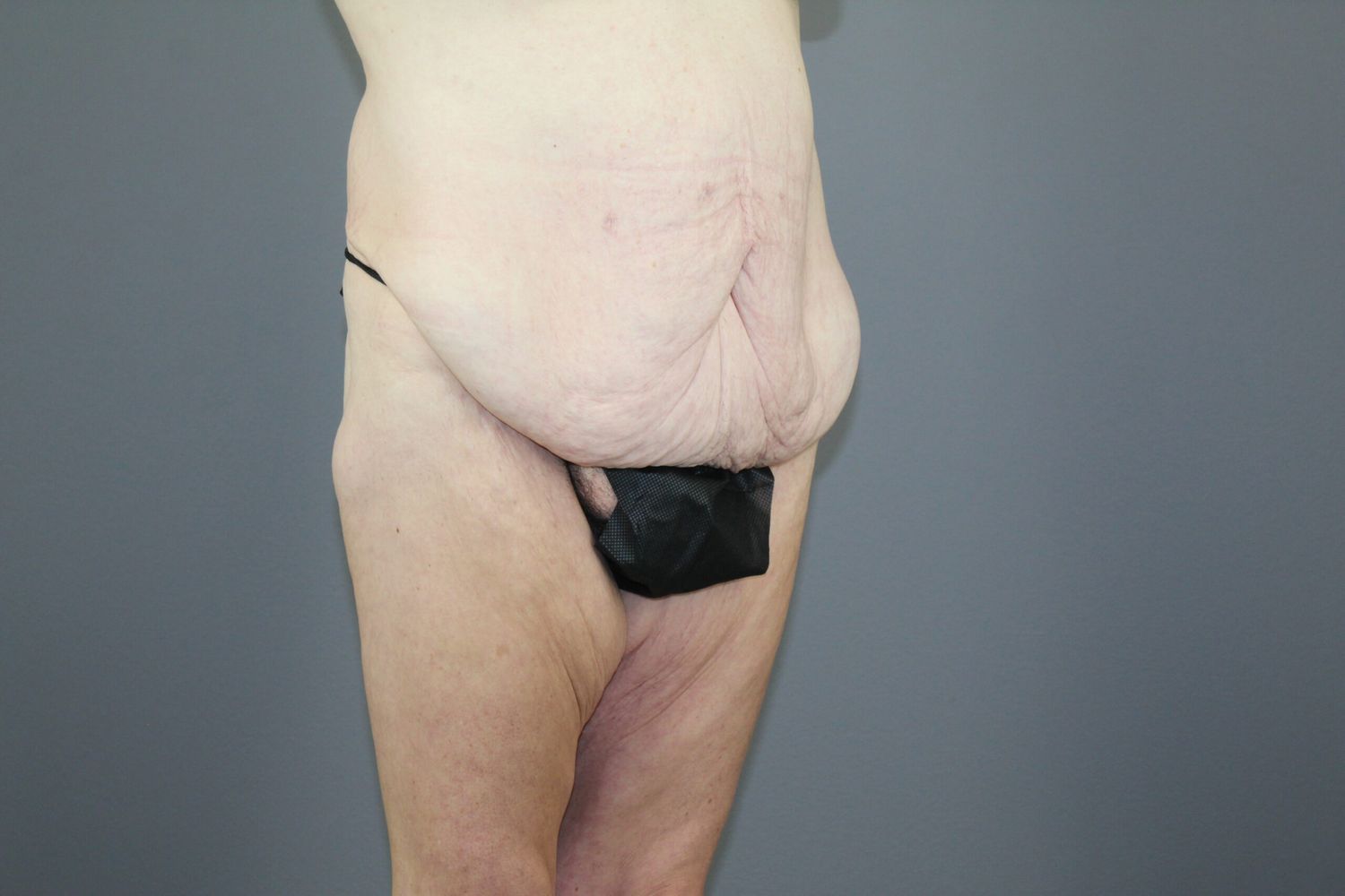 Surgery After Weight Loss Before & After